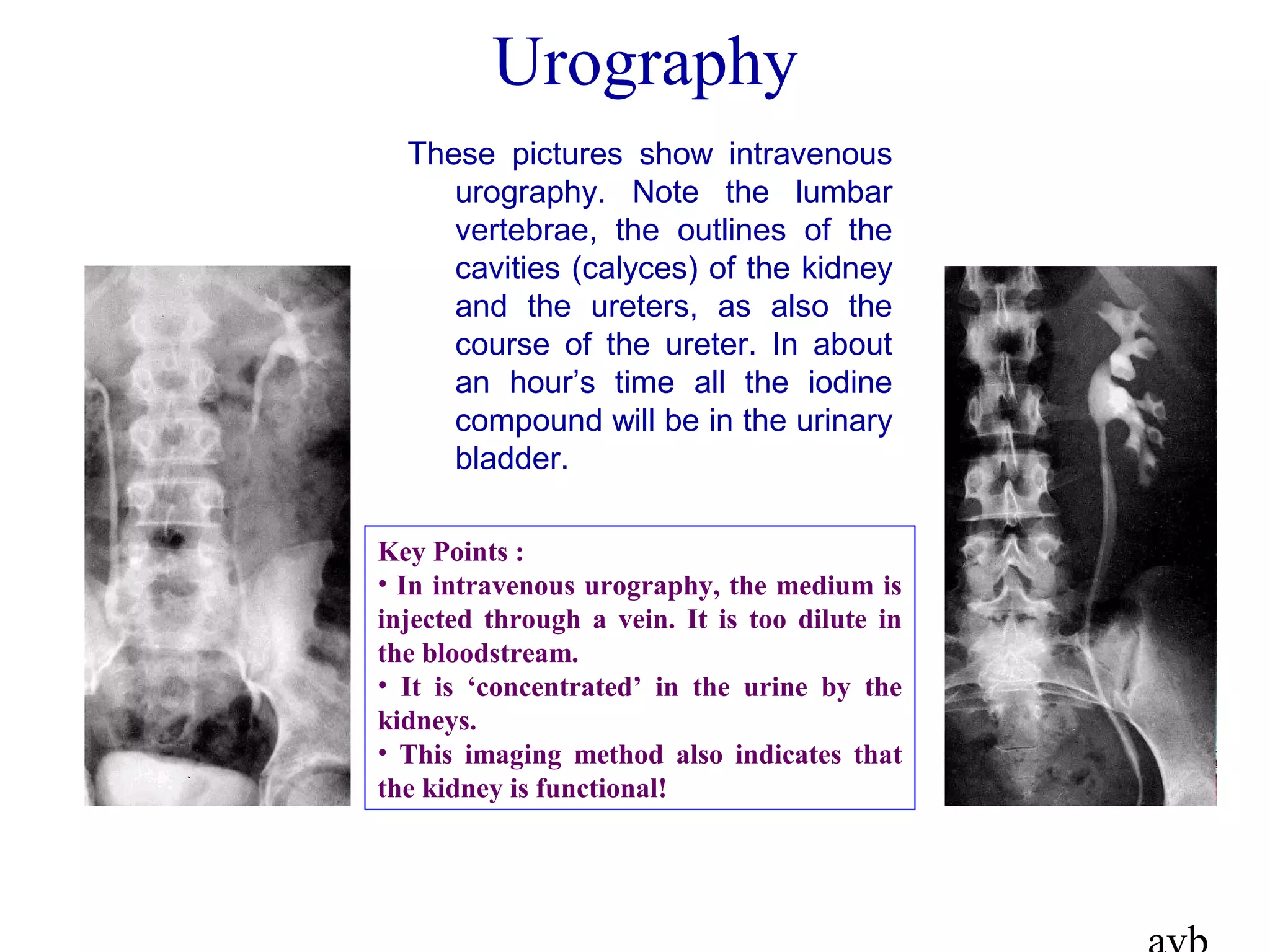 Urography
These pictures show intravenous
urography. Note the lumbar
vertebrae, the outlines of the
cavities (calyces) of the kidney
and the ureters, as also the
course of the ureter. In about
an hour’s time all the iodine
compound will be in the urinary
bladder.
Key Points :
• In intravenous urography, the medium is
injected through a vein. It is too dilute in
the bloodstream.
• It is ‘concentrated’ in the urine by the
kidneys.
• This imaging method also indicates that
the kidney is functional!
 