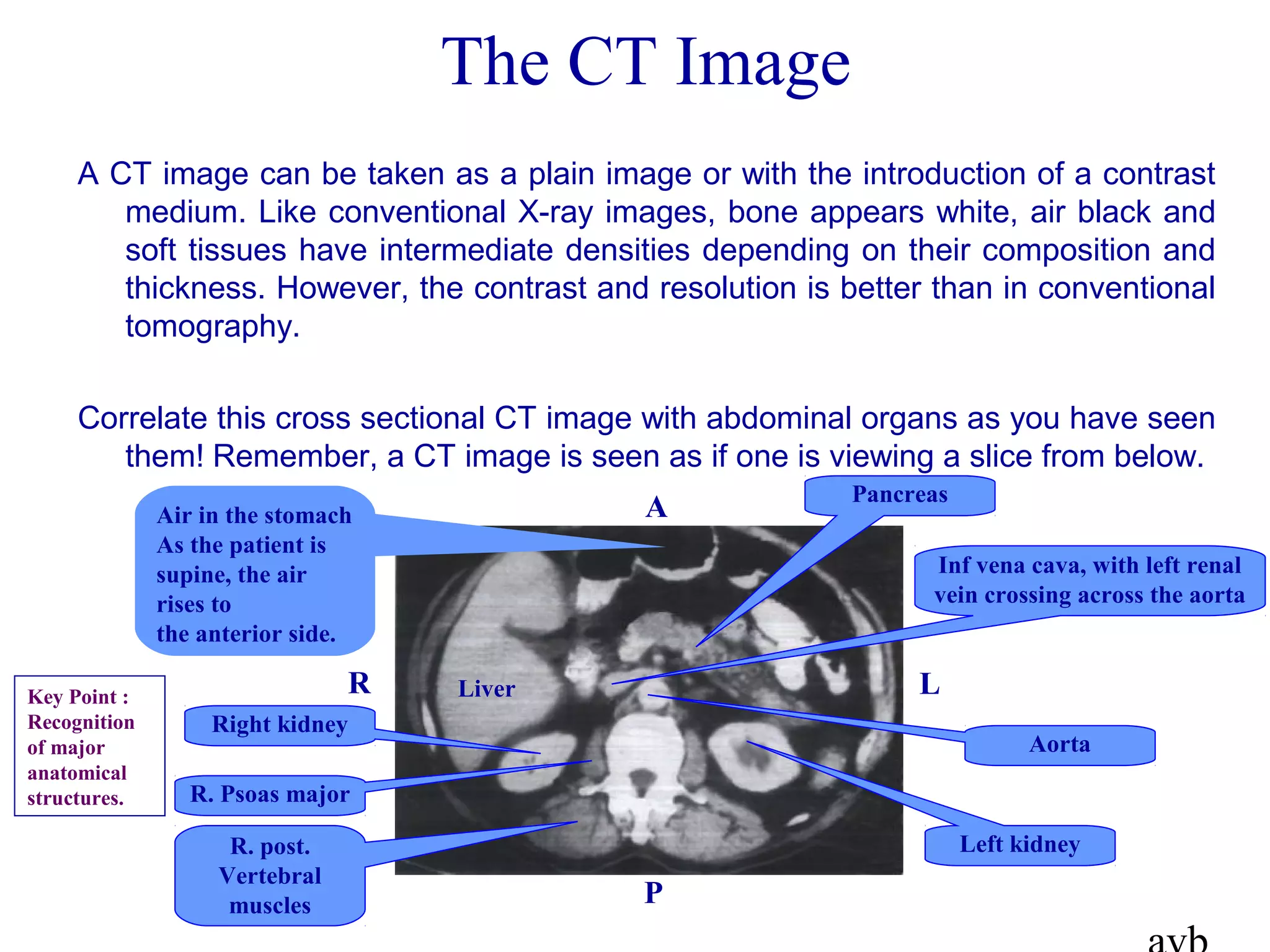 The CT Image
A CT image can be taken as a plain image or with the introduction of a contrast
medium. Like conventional X-ray images, bone appears white, air black and
soft tissues have intermediate densities depending on their composition and
thickness. However, the contrast and resolution is better than in conventional
tomography.
Correlate this cross sectional CT image with abdominal organs as you have seen
them! Remember, a CT image is seen as if one is viewing a slice from below.
A
P
R LLiver
Air in the stomach
As the patient is
supine, the air
rises to
the anterior side.
Right kidney
R. Psoas major
R. post.
Vertebral
muscles
Pancreas
Left kidney
Aorta
Inf vena cava, with left renal
vein crossing across the aorta
Key Point :
Recognition
of major
anatomical
structures.
 