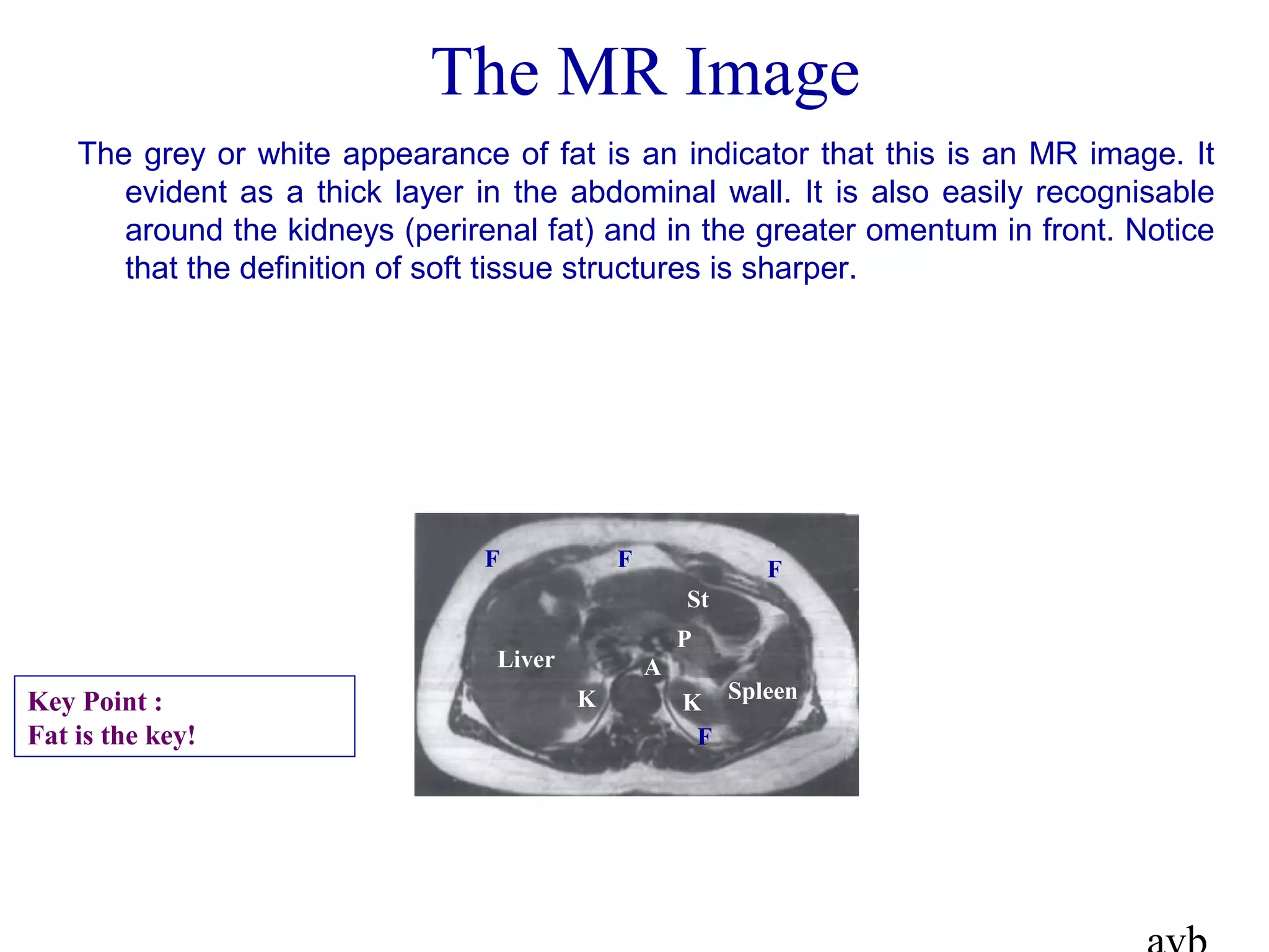 The MR Image
The grey or white appearance of fat is an indicator that this is an MR image. It
evident as a thick layer in the abdominal wall. It is also easily recognisable
around the kidneys (perirenal fat) and in the greater omentum in front. Notice
that the definition of soft tissue structures is sharper.
F F F
F
Liver
SpleenKK
A
P
St
Key Point :
Fat is the key!
 