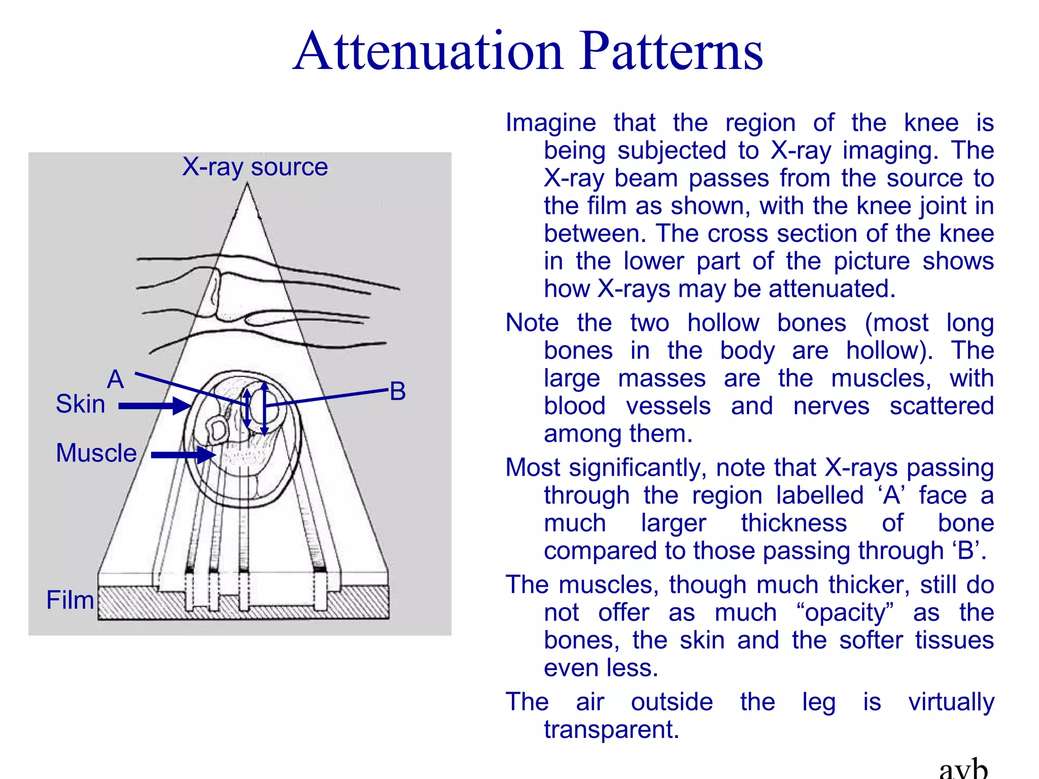 Attenuation Patterns
X-ray source
Film
Muscle
Skin
A B
Imagine that the region of the knee is
being subjected to X-ray imaging. The
X-ray beam passes from the source to
the film as shown, with the knee joint in
between. The cross section of the knee
in the lower part of the picture shows
how X-rays may be attenuated.
Note the two hollow bones (most long
bones in the body are hollow). The
large masses are the muscles, with
blood vessels and nerves scattered
among them.
Most significantly, note that X-rays passing
through the region labelled ‘A’ face a
much larger thickness of bone
compared to those passing through ‘B’.
The muscles, though much thicker, still do
not offer as much “opacity” as the
bones, the skin and the softer tissues
even less.
The air outside the leg is virtually
transparent.
 
