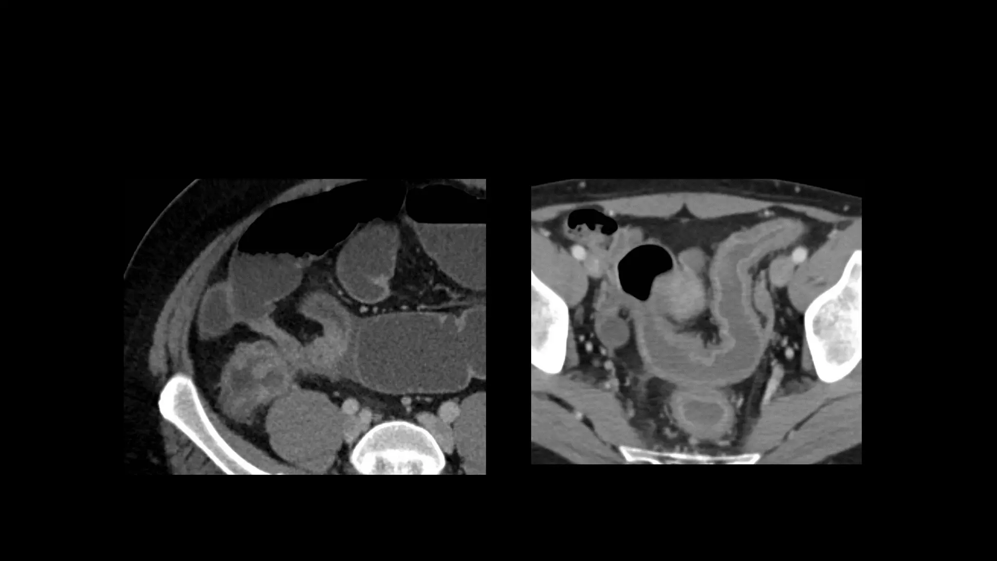 imaging in uc and chrons disease (1).pptx