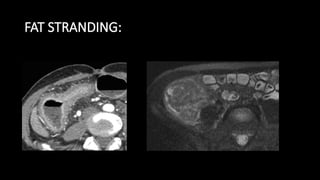 Pyelo Fat Stranding imaging in uc and chrons disease (1).pptx