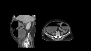 imaging in uc and chrons disease (1).pptx
