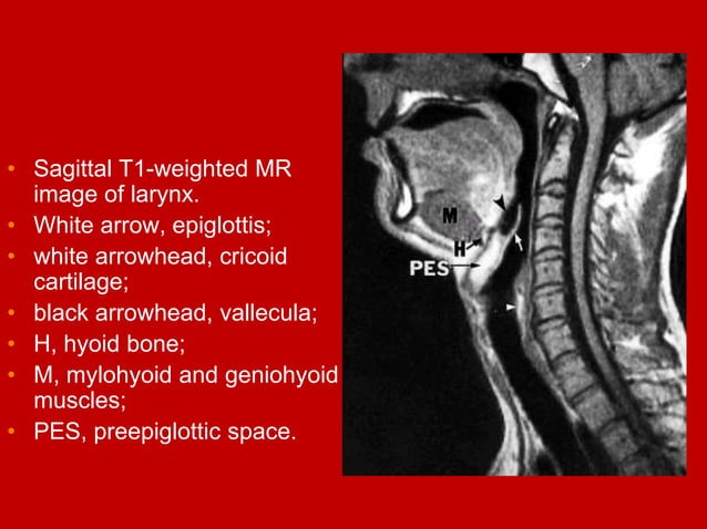 larynx Imaging 1st part laryngeal anatomy CT MRI Dr Ahmed Esawy
