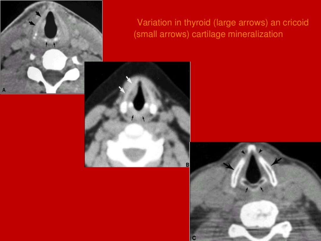 larynx Imaging 1st part laryngeal anatomy CT MRI Dr Ahmed Esawy