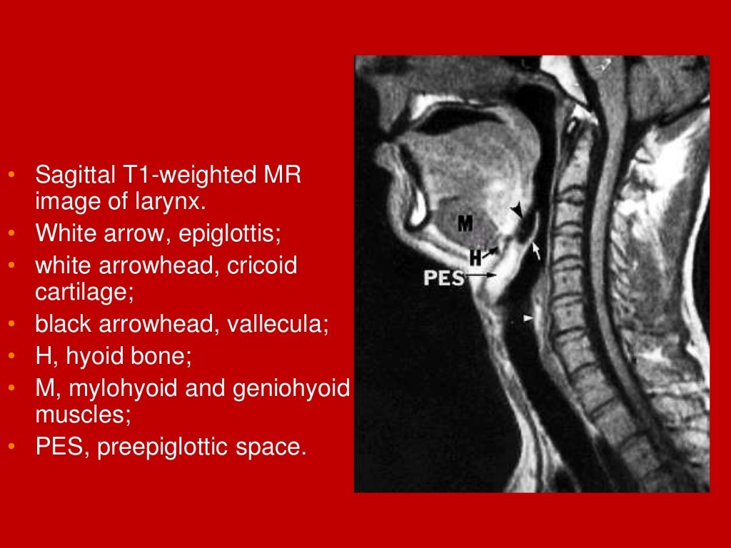larynx Imaging 1st part laryngeal anatomy CT MRI Dr Ahmed Esawy