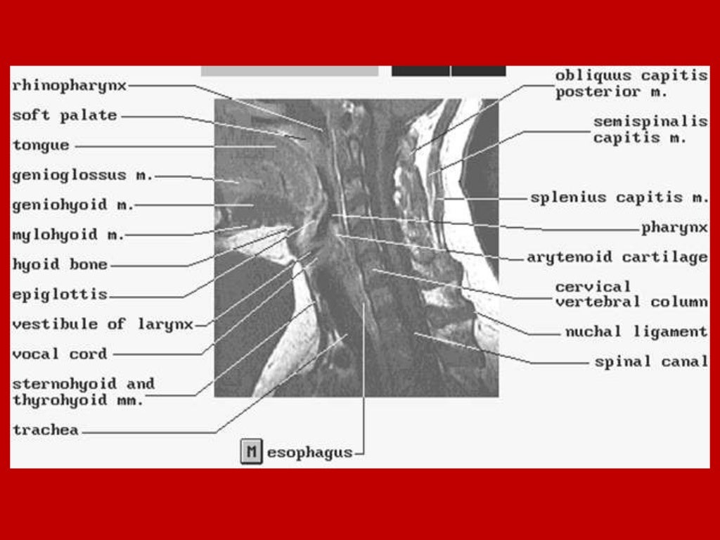 larynx Imaging 1st part laryngeal anatomy CT MRI Dr Ahmed Esawy