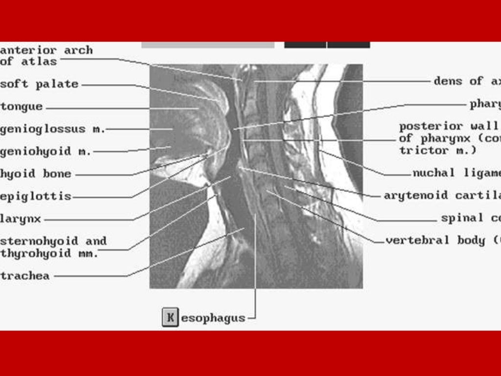 larynx Imaging 1st part laryngeal anatomy CT MRI Dr Ahmed Esawy