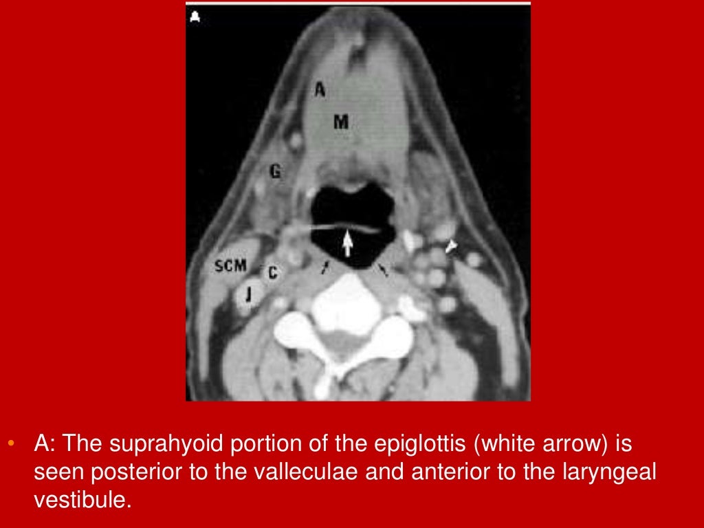 larynx Imaging 1st part laryngeal anatomy CT MRI Dr Ahmed Esawy