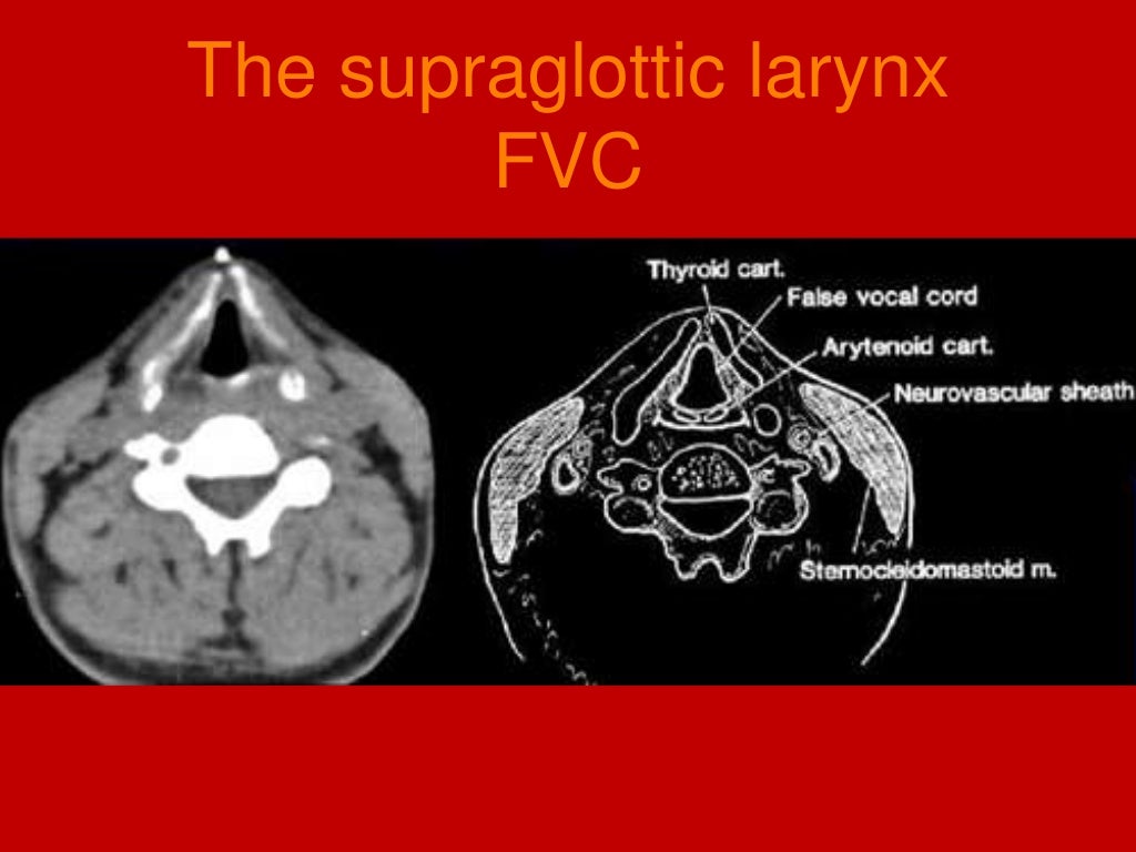 larynx Imaging 1st part laryngeal anatomy CT MRI Dr Ahmed Esawy