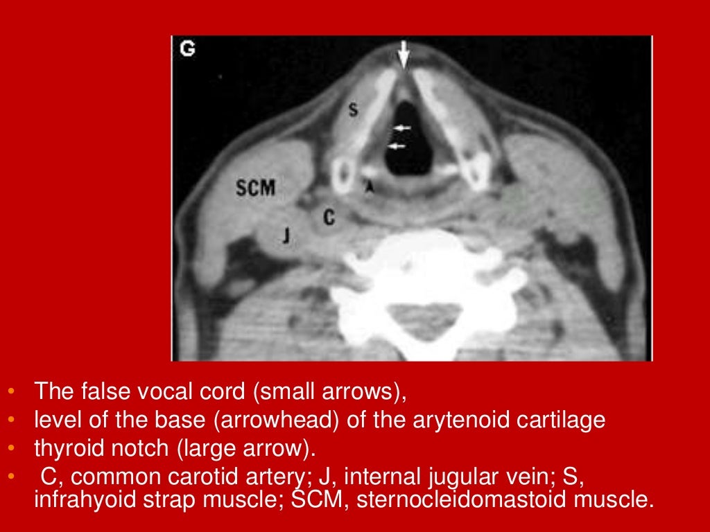 larynx Imaging 1st part laryngeal anatomy CT MRI Dr Ahmed Esawy