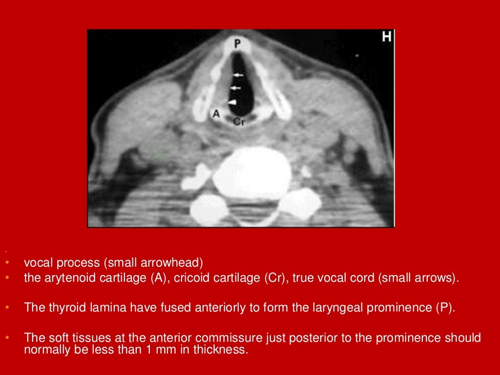 larynx Imaging 1st part laryngeal anatomy CT MRI Dr Ahmed Esawy