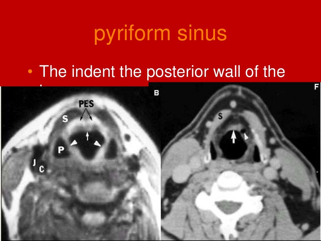 larynx Imaging 1st part laryngeal anatomy CT MRI Dr Ahmed Esawy