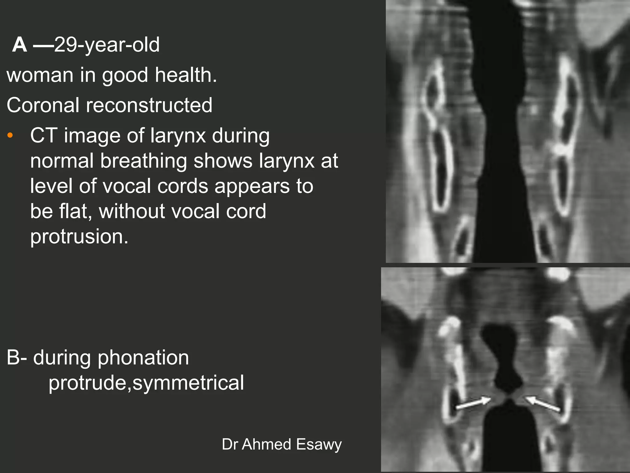 Larynx Imaging 4th part virtual laryngoscopy vocal cord paralysis CT ...