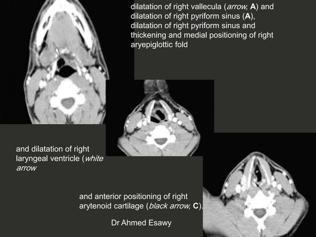 Larynx Imaging 4th part virtual laryngoscopy vocal cord paralysis CT ...