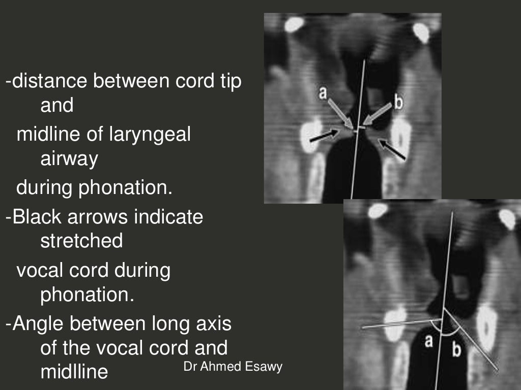 Larynx Imaging 4th part virtual laryngoscopy vocal cord paralysis CT