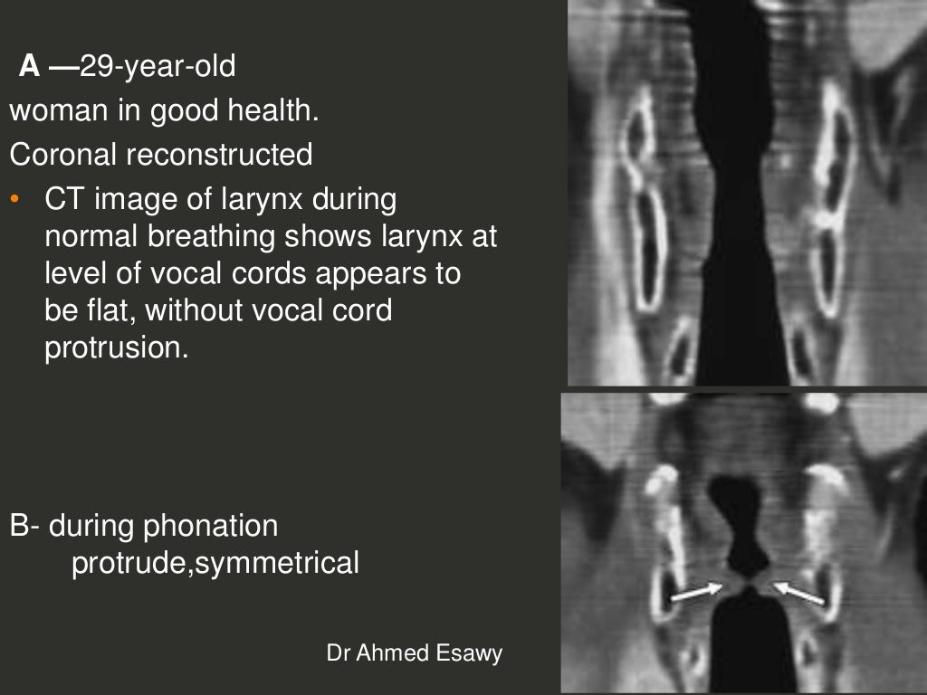Larynx Imaging 4th part virtual laryngoscopy vocal cord paralysis CT