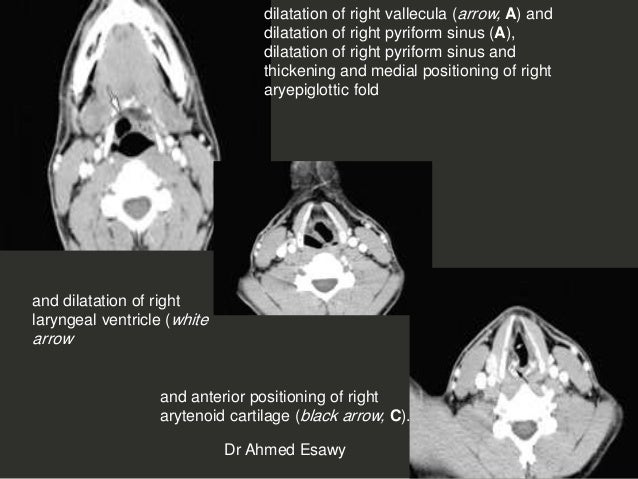 Larynx Imaging 4th part virtual laryngoscopy vocal cord paralysis CT