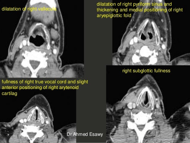 Larynx Imaging 4th part virtual laryngoscopy vocal cord paralysis CT