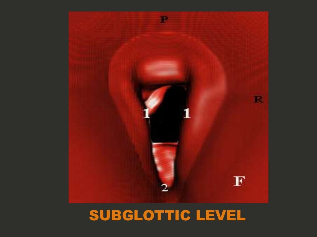 Larynx Imaging 4th part virtual laryngoscopy vocal cord paralysis CT