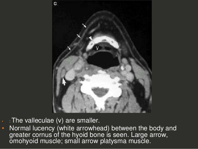 Full Story larynx Imaging CT MRI Dr Ahmed Esawy