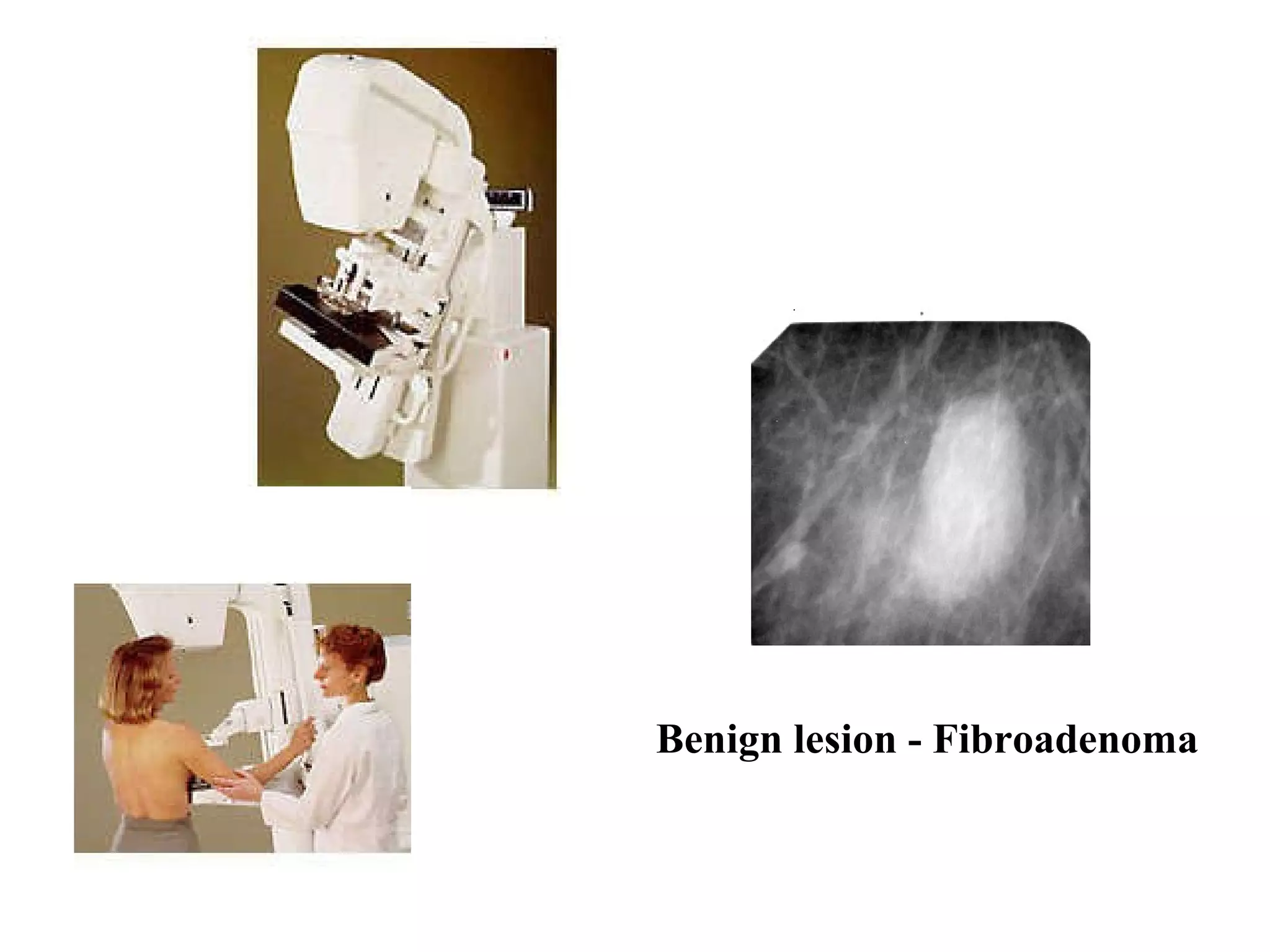 Benign lesion - Fibroadenoma   