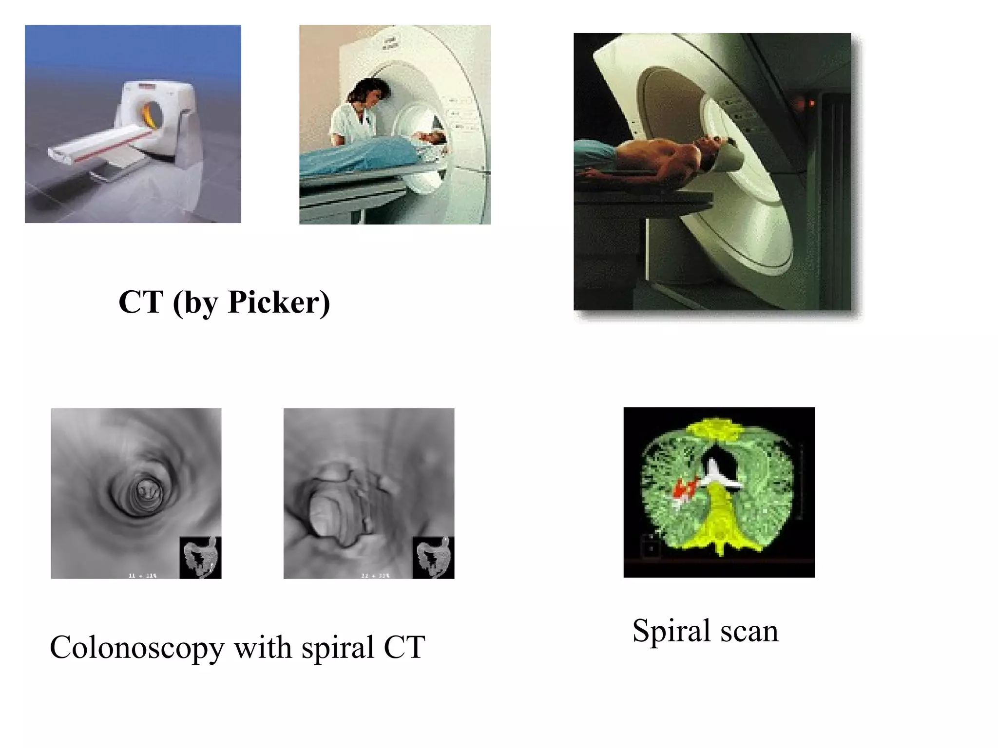 Colonoscopy with spiral CT  Spiral scan CT (by Picker)   