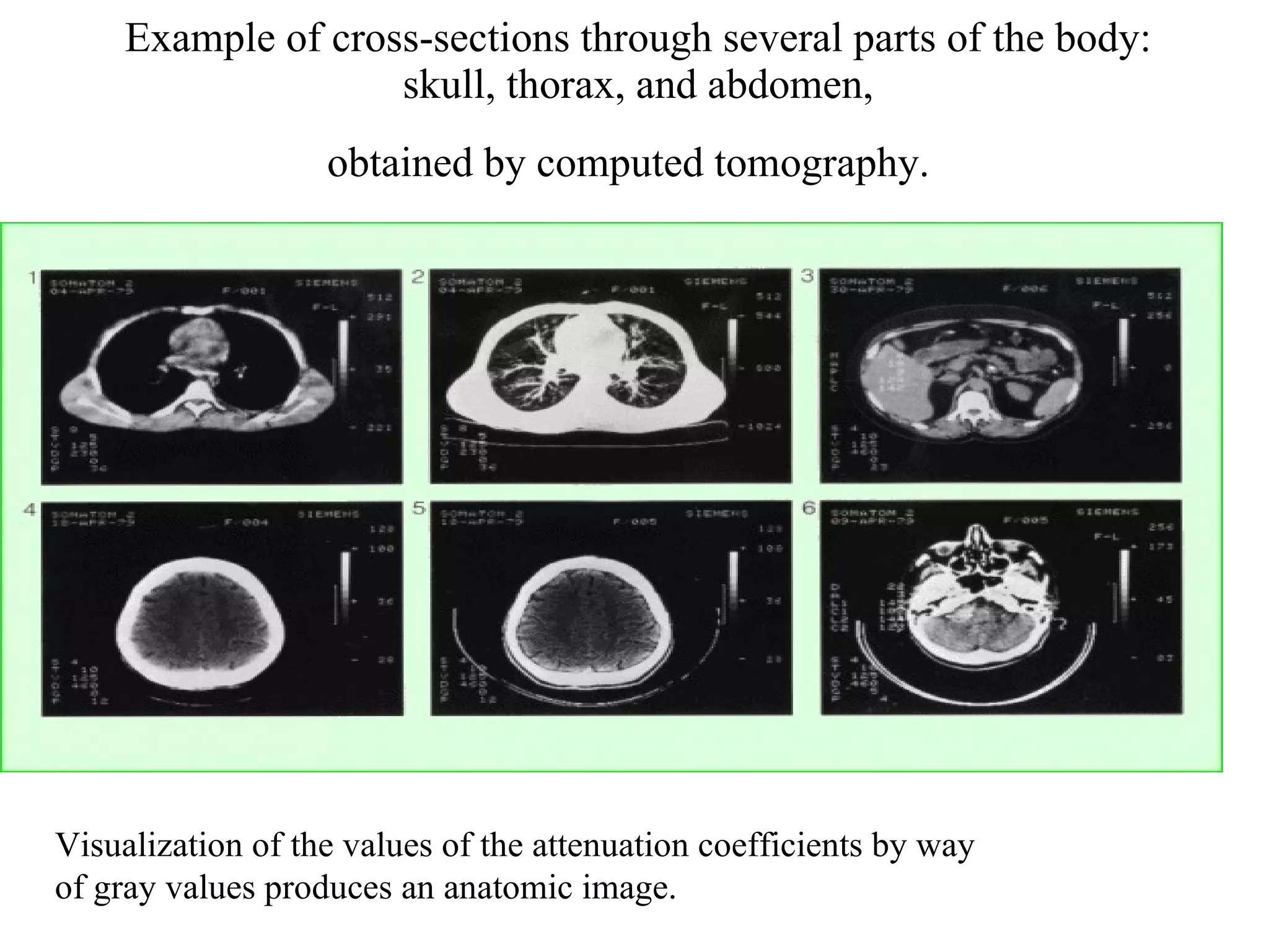 Example of cross-sections through several parts of the body: skull, thorax, and abdomen, obtained by computed tomography.   Visualization of the values of the attenuation coefficients by way  of gray values produces an anatomic image. 