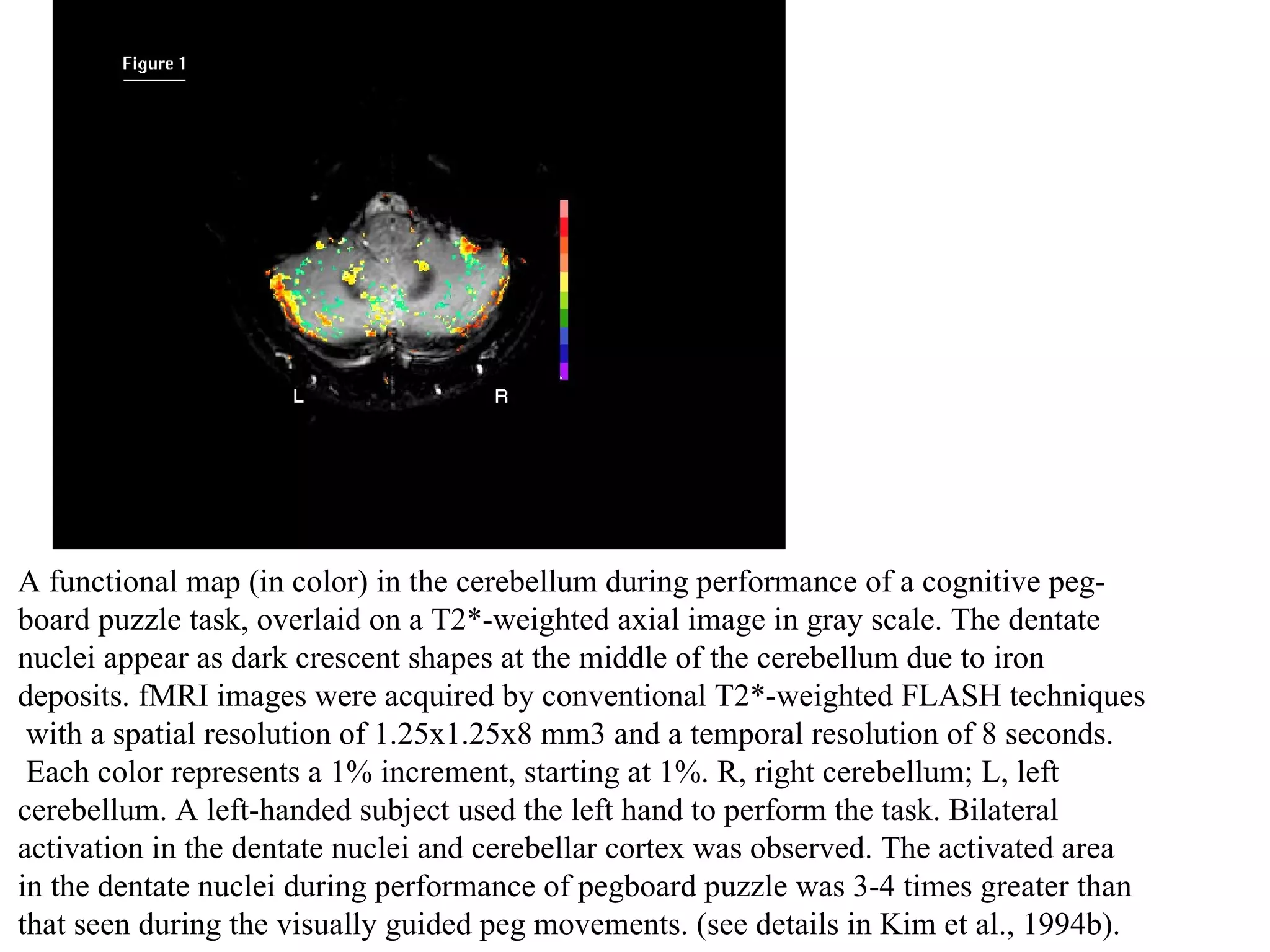 A functional map (in color) in the cerebellum during performance of a cognitive peg- board puzzle task, overlaid on a T2*-weighted axial image in gray scale. The dentate  nuclei appear as dark crescent shapes at the middle of the cerebellum due to iron  deposits. fMRI images were acquired by conventional T2*-weighted FLASH techniques with a spatial resolution of 1.25x1.25x8 mm3 and a temporal resolution of 8 seconds. Each color represents a 1% increment, starting at 1%. R, right cerebellum; L, left  cerebellum. A left-handed subject used the left hand to perform the task. Bilateral  activation in the dentate nuclei and cerebellar cortex was observed. The activated area  in the dentate nuclei during performance of pegboard puzzle was 3-4 times greater than  that seen during the visually guided peg movements. (see details in Kim et al., 1994b).  