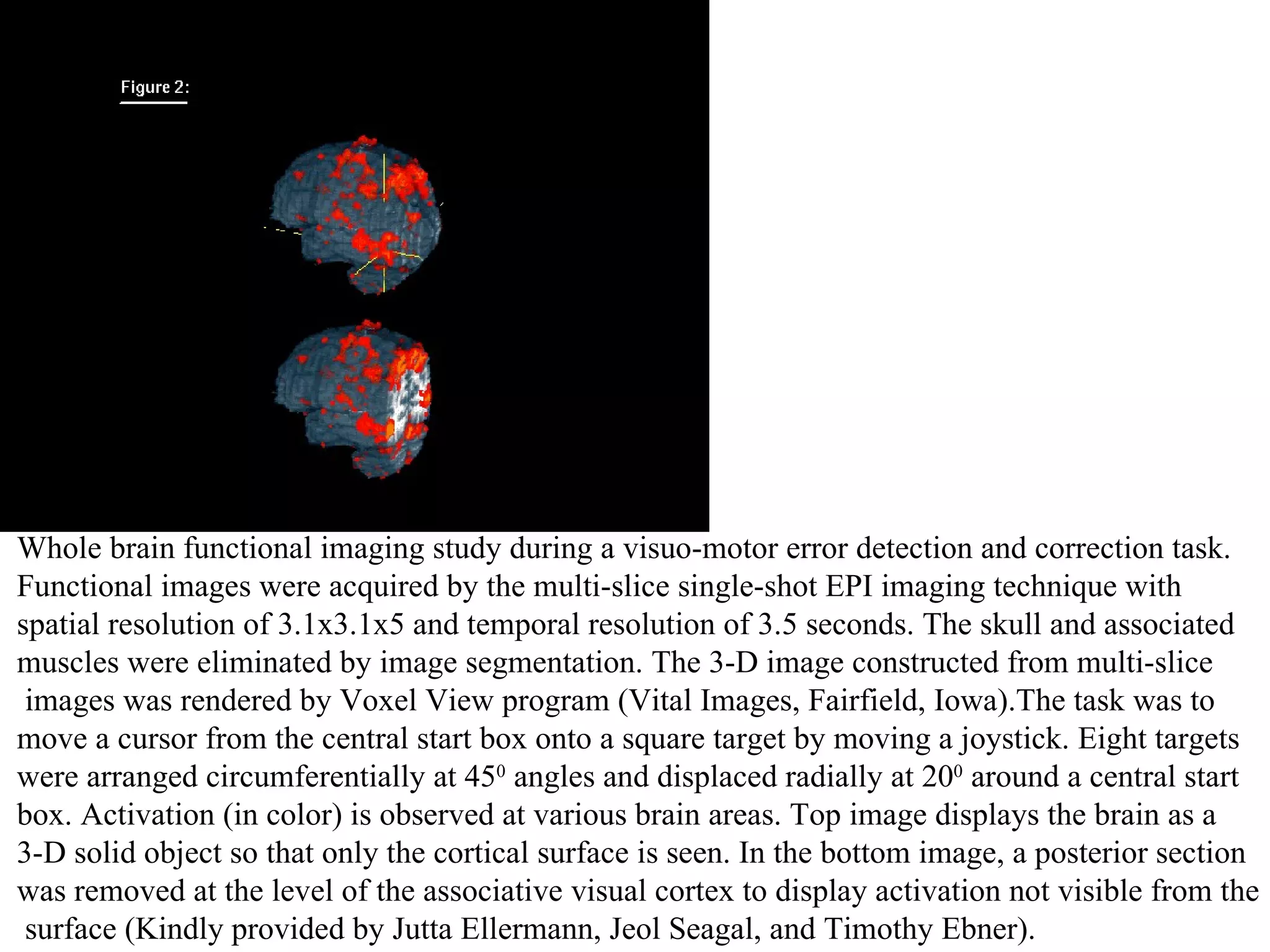 Whole brain functional imaging study during a visuo-motor error detection and correction task.  Functional images were acquired by the multi-slice single-shot EPI imaging technique with  spatial resolution of 3.1x3.1x5 and temporal resolution of 3.5 seconds. The skull and associated  muscles were eliminated by image segmentation. The 3-D image constructed from multi-slice images was rendered by Voxel View program (Vital Images, Fairfield, Iowa).The task was to  move a cursor from the central start box onto a square target by moving a joystick. Eight targets  were arranged circumferentially at 45 0   angles and displaced radially at 20 0  around a central start  box. Activation (in color) is observed at various brain areas. Top image displays the brain as a  3-D solid object so that only the cortical surface is seen. In the bottom image, a posterior section  was removed at the level of the associative visual cortex to display activation not visible from the surface (Kindly provided by Jutta Ellermann, Jeol Seagal, and Timothy Ebner). 