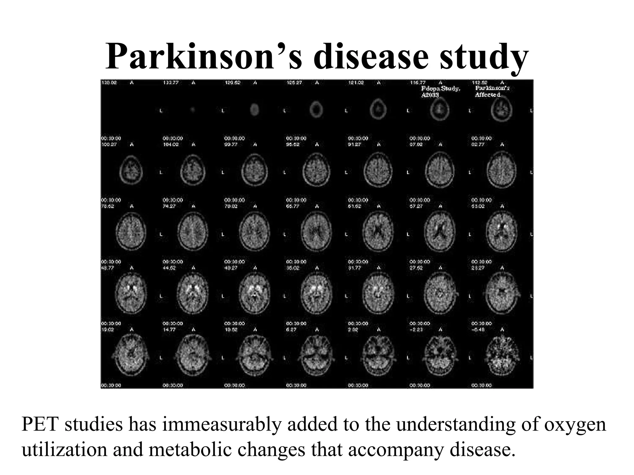 Parkinson’s disease study PET studies has immeasurably added to the understanding of oxygen  utilization and metabolic changes that accompany disease. 