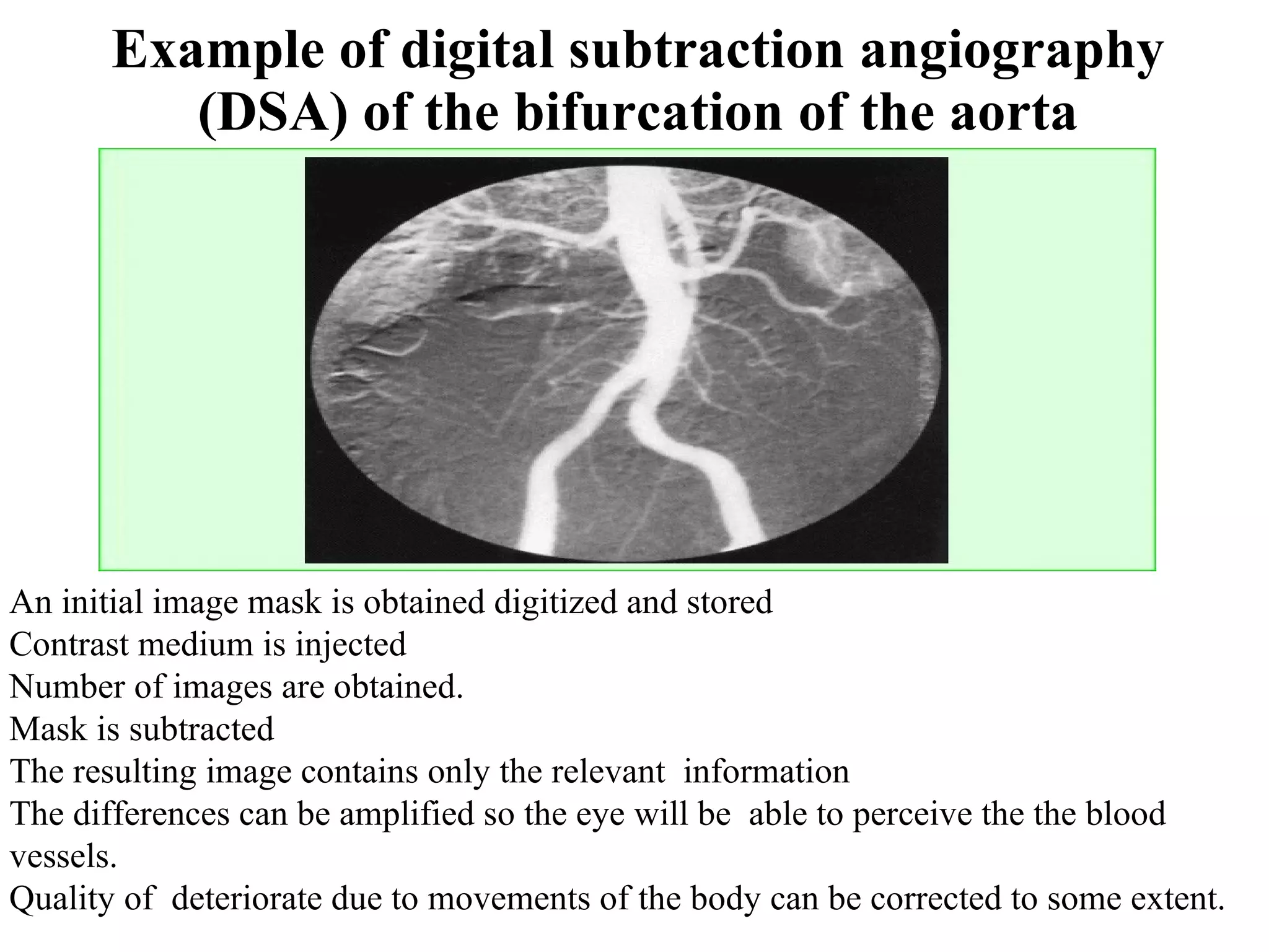 Example of digital subtraction angiography (DSA) of the bifurcation of the aorta An initial image mask is obtained digitized and stored Contrast medium is injected Number of images are obtained. Mask is subtracted The resulting image contains only the relevant  information The differences can be amplified so the eye will be  able to perceive the the blood  vessels. Quality of  deteriorate due to movements of the body can be corrected to some extent. 