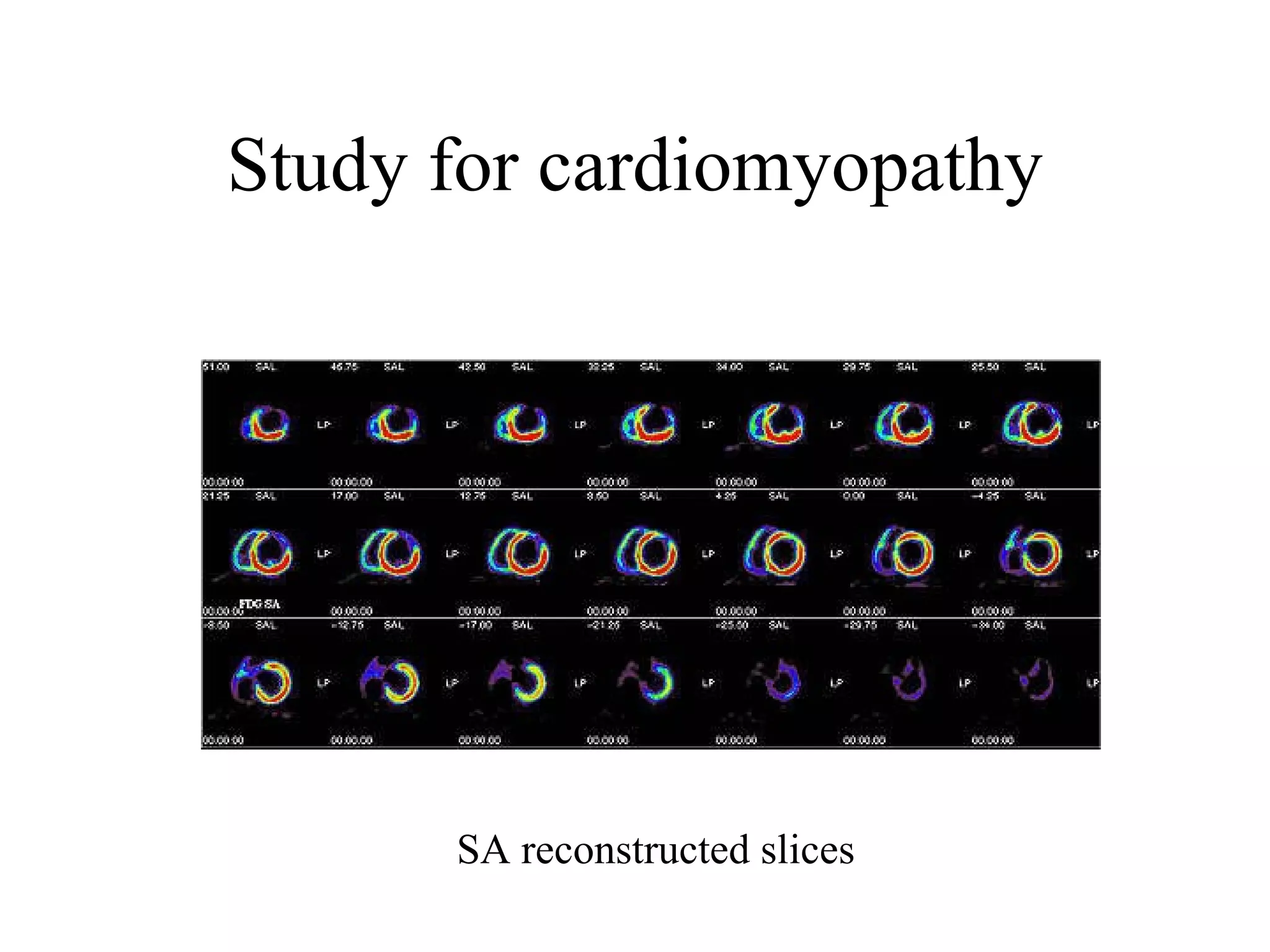 Study for cardiomyopathy SA reconstructed slices 