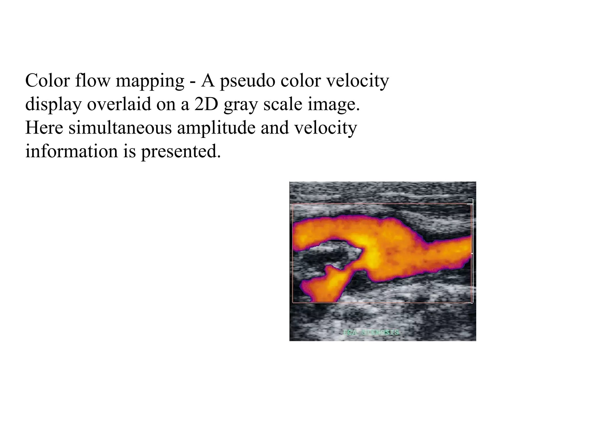 Color flow mapping - A pseudo color velocity  display overlaid on a 2D gray scale image.  Here simultaneous amplitude and velocity  information is presented.  