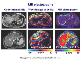 MR elastography
Mariappan YK. Clinical Anatomy 2010 ; 23 : 497 – 511.
Conventional MR Wave images at 60 Hz
Shorter wavelen...