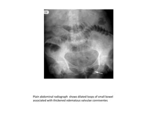 Valvulae Imaging modalities of intestinal obstruction Mithilesh Kumar Medical ...