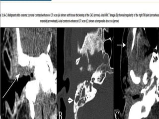 Imaging modalities of the petrous bone | PPTX