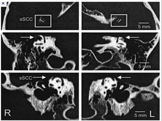 Imaging modalities of the petrous bone | PPTX