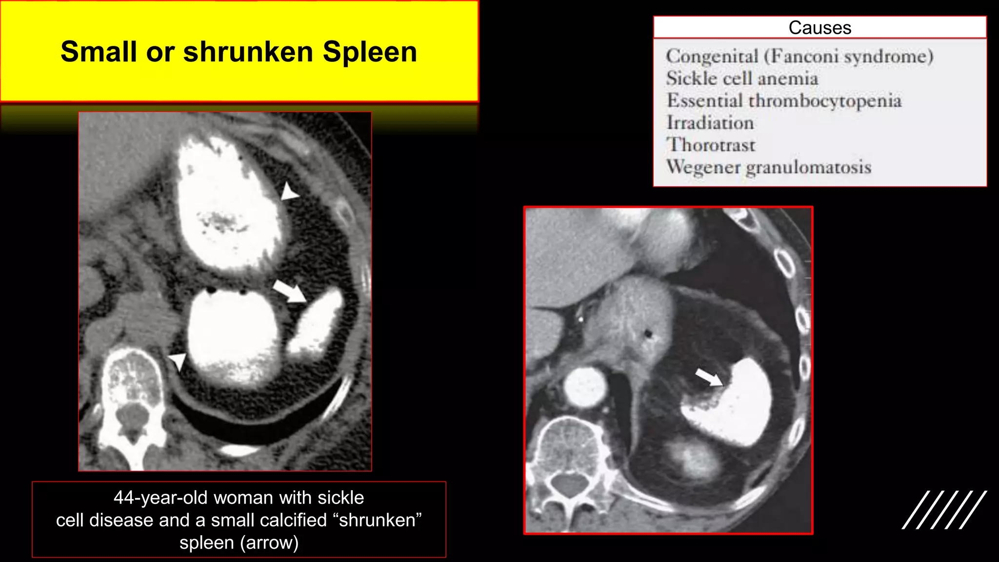 Imaging ofsplenic diseases [Autosaved].pptx