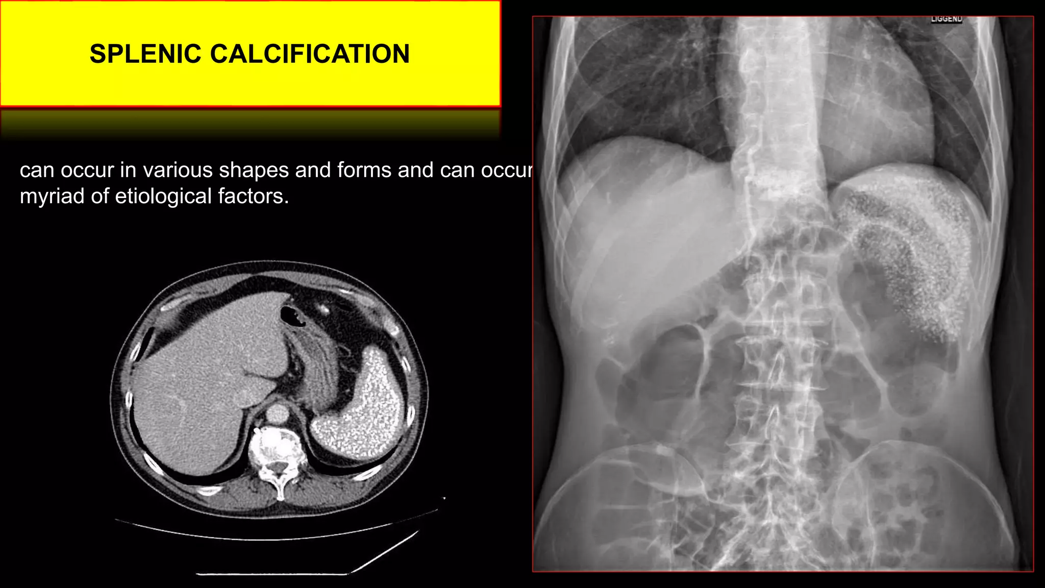 Imaging ofsplenic diseases [Autosaved].pptx