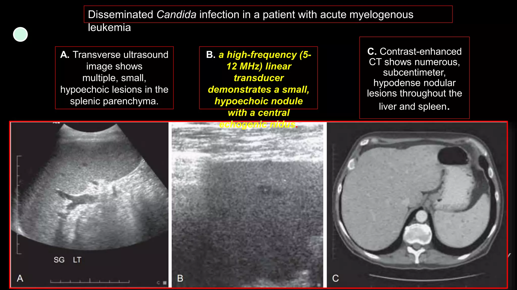Imaging ofsplenic diseases [Autosaved].pptx