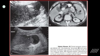 Imaging ofsplenic diseases [Autosaved].pptx