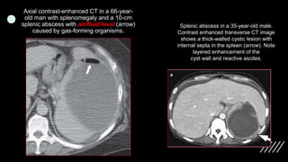 Imaging ofsplenic diseases [Autosaved].pptx
