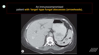 Imaging ofsplenic diseases [Autosaved].pptx