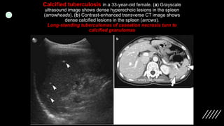 Imaging ofsplenic diseases [Autosaved].pptx