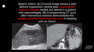 Imaging ofsplenic diseases [Autosaved].pptx