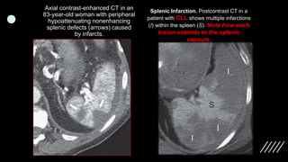 Imaging ofsplenic diseases [Autosaved].pptx