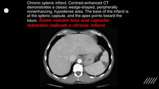 Imaging ofsplenic diseases [Autosaved].pptx
