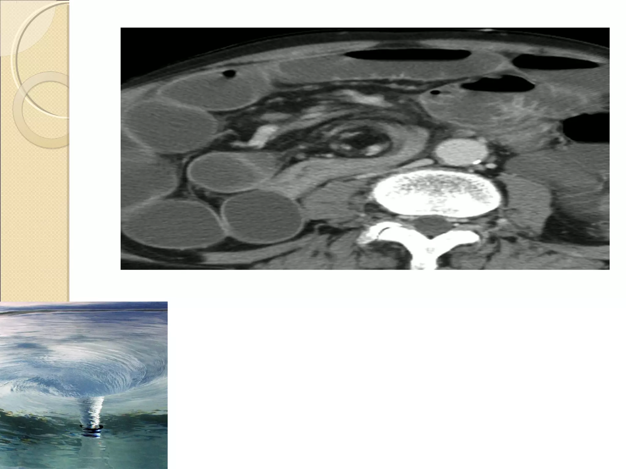 Imaging of acute abdomen | PPT