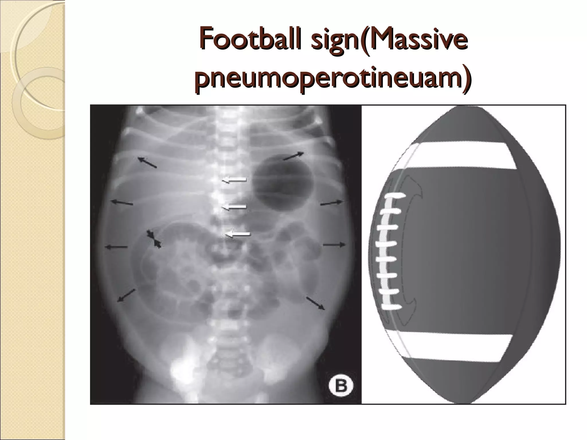 Imaging of acute abdomen | PPT
